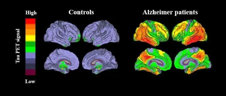 Brain scan comparison showing Tau PET signal in controls vs Alzheimer patients